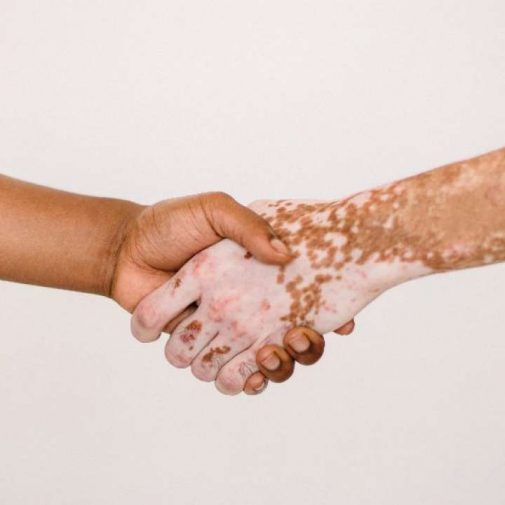remedios para el vitiligo